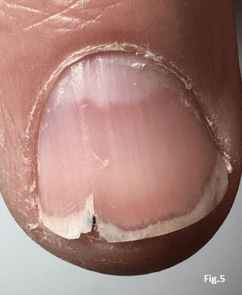 Vertical split of the nail plate - brittle nails