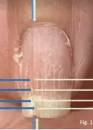 Nail damage caused by overpinching