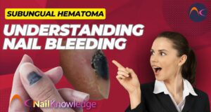Hematoma subungueal Hemorragia ungueal