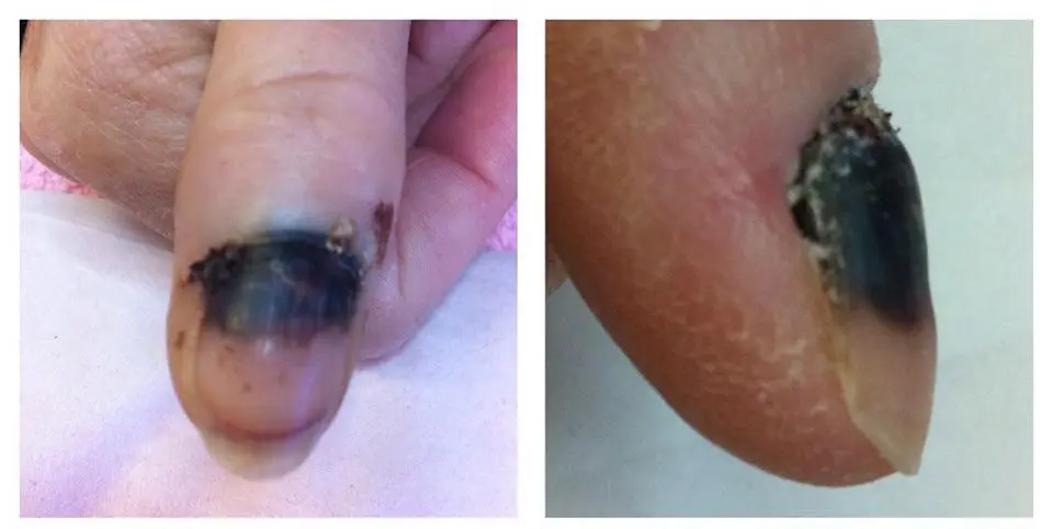 Subungual Hematoma brusied nail