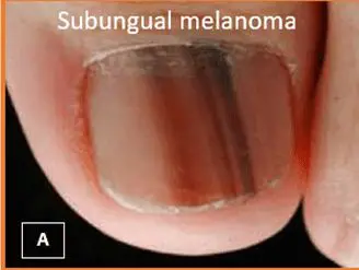 Melanoma - Unhas - Foto