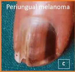 Imagem de unhas com melanoma