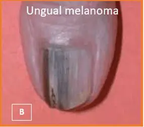 Melanoma - Unhas