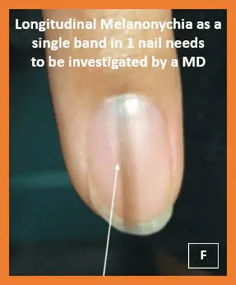 melanonychia in single nail