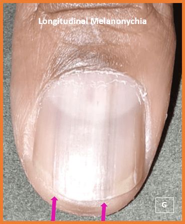 Fungal nail infection | NHS inform