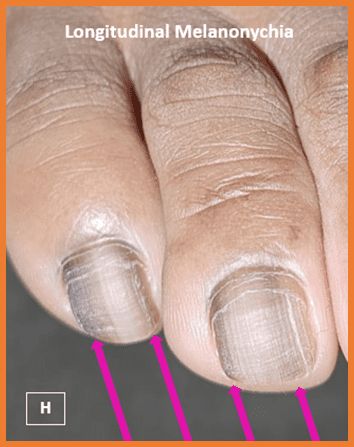 Melanoma longitudinal das unhas  