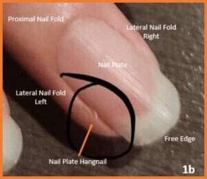Hangnails - NailKnowledge