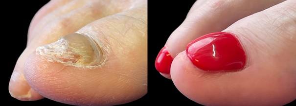 Cosmetic strengthening of the nail plate