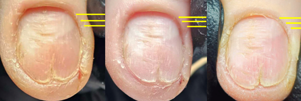 nail plate habbit tick