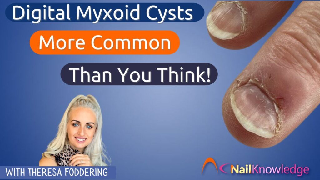 U nang Myxoid kỹ thuật số