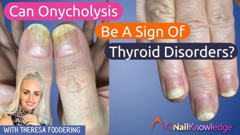 Can Onycholysis be a sign of Thyroid Disorders