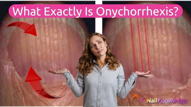 What Exactly Is Onychorrhexis and its impact on nail health