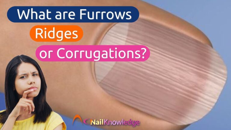 Nail Furrows, Ridges or Corrugations