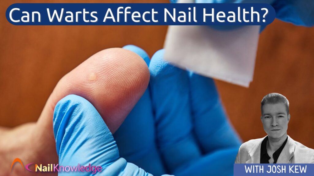 Can Warts Affect Nail Health