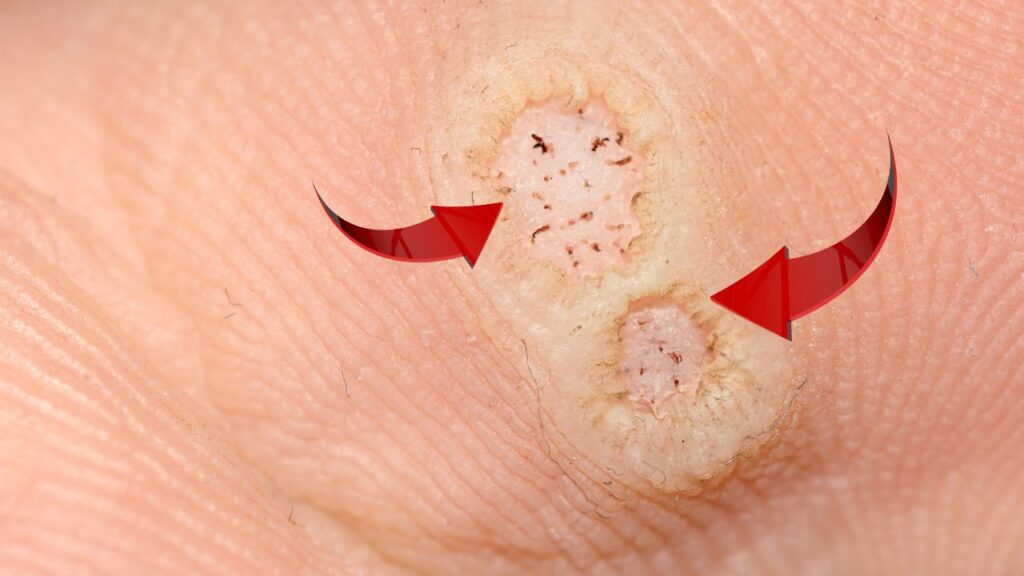 Plantar Warts