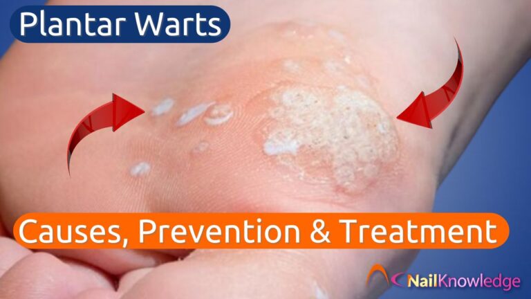 Can Warts Affect Nail Health