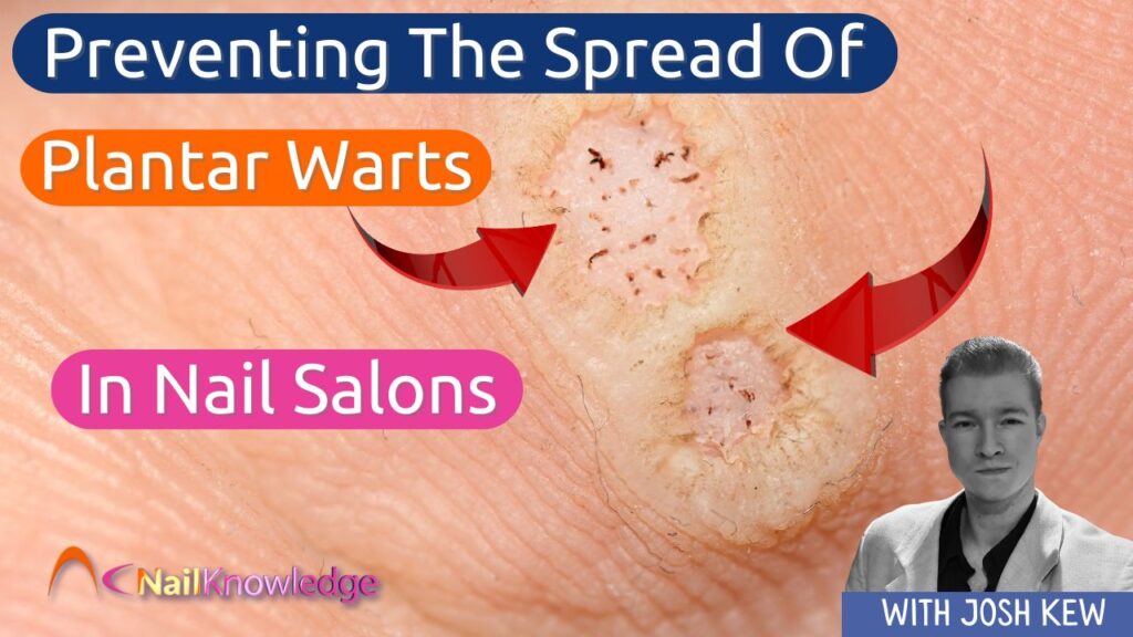 Preventing the Spread of Warts in Nail Salons