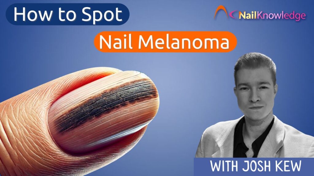 Como identificar um melanoma nas unhas