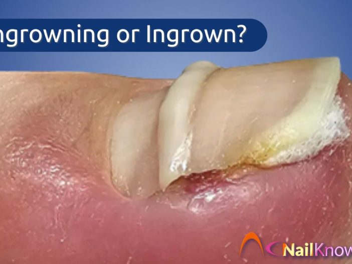 Ingrowing Toe Nail - Ingrown Toenail