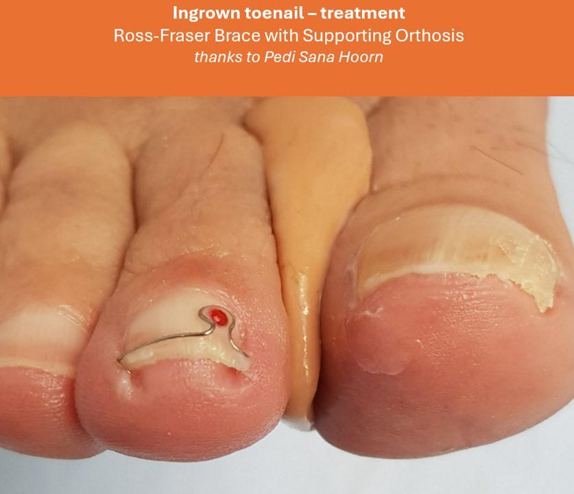 Ingrown toenail – treatment pedi sani hoorn