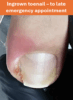 Ingrowing or Ingrown Toenail – Causes, Symptoms and Care Advice ...